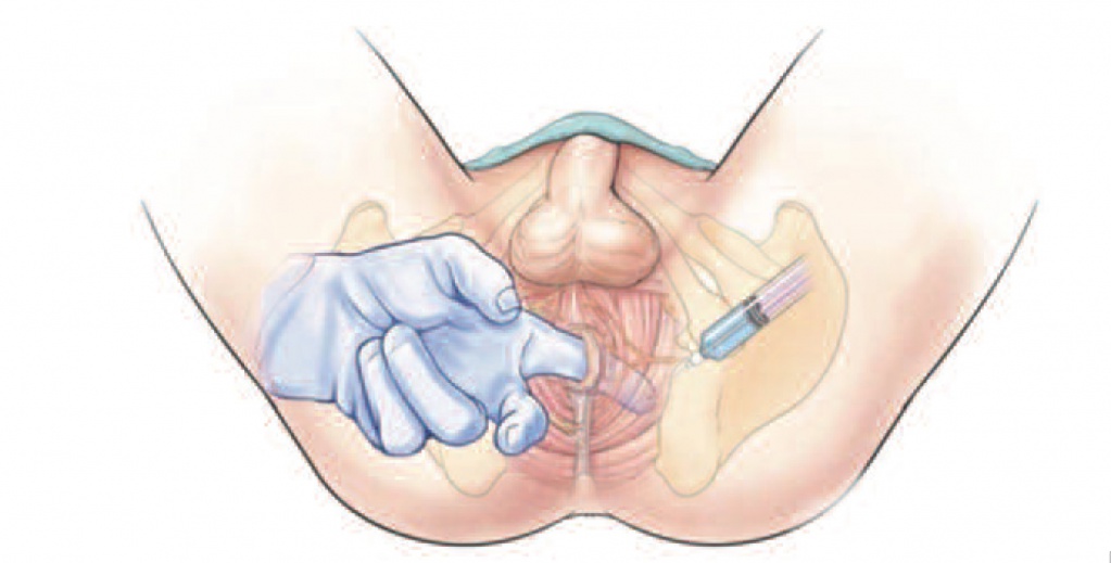 Выполнение инъекции анестетика в m.levator ani