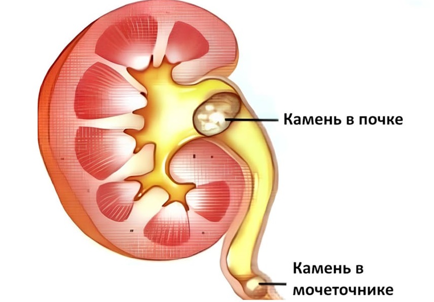 Мочекаменная болезнь Мочекаменная болезнь